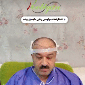 نمونه کاشت مو کلینیک زیبایی روبیان