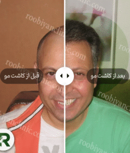 نمونه کاشت مو کلینیک زیبایی روبیان
