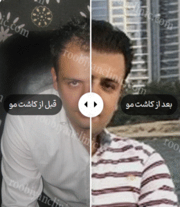 نمونه کاشت مو کلینیک زیبایی روبیان