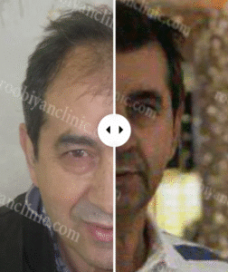 نمونه کاشت مو کلینیک زیبایی روبیان