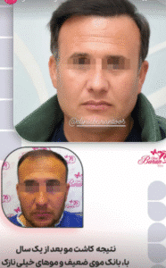 نمونه کاشت مو کلینیک باران توس