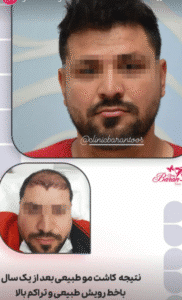 نمونه کاشت مو کلینیک باران توس