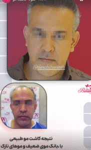 نمونه کاشت مو کلینیک باران توس