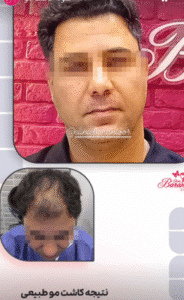 نمونه کاشت مو کلینیک باران توس