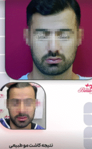 نمونه کاشت مو کلینیک باران توس