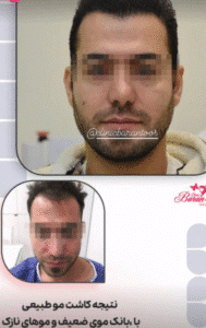 نمونه کاشت مو کلینیک باران توس