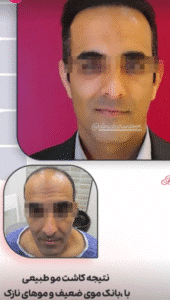 نمونه کاشت مو کلینیک باران توس
