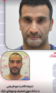 نمونه کاشت مو کلینیک باران توس
