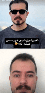 نمونه کاشت مو کلینیک باران توس