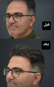 نمونه کاشت مو کلینیک باران توس