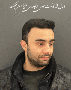 نمونه کاشت مو کلینیک باران توس