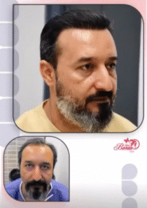 نمونه کاشت مو کلینیک باران توس