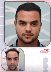 نمونه کاشت مو کلینیک باران توس