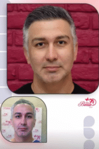 نمونه کاشت مو کلینیک باران توس