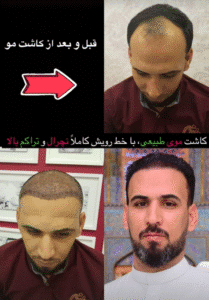 نمونه کاشت مو کلینیک باران توس