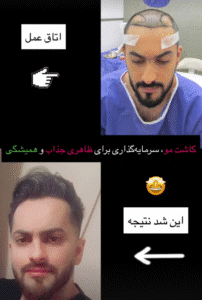 نمونه کاشت مو کلینیک باران توس