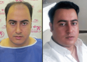 نمونه کاشت مو کلینیک باران توس