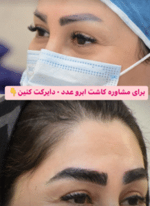 نمونه کاشت ابرو کلینیک باران توس