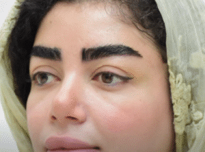 نمونه کاشت ابرو کلینیک باران توس