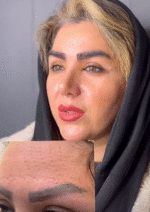 نمونه کاشت ابرو کلینیک باران توس