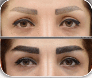 نمونه کاشت ابرو کلینیک باران توس