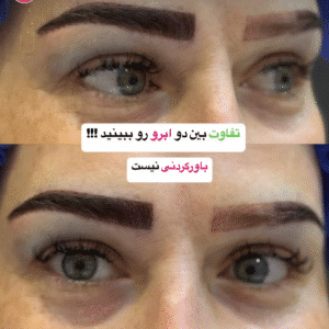 نمونه کاشت ابرو کلینیک باران توس