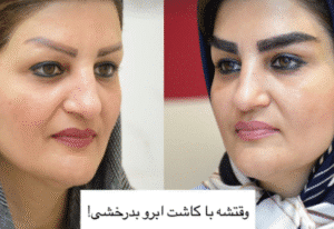 نمونه کاشت ابرو کلینیک باران توس