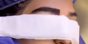 نمونه کاشت ابرو کلینیک باران توس