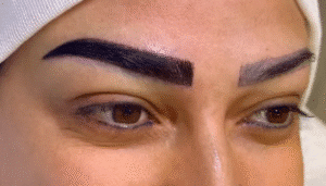 نمونه کاشت ابرو کلینیک باران توس