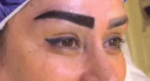 نمونه کاشت ابرو کلینیک باران توس