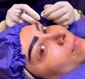 نمونه کاشت ابرو کلینیک باران توس