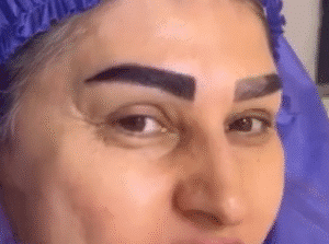 نمونه کاشت ابرو کلینیک باران توس
