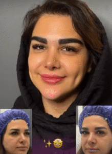 نمونه کاشت ابرو کلینیک باران توس