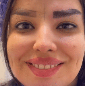 نمونه کاشت ابرو کلینیک زیبایی دنیز
