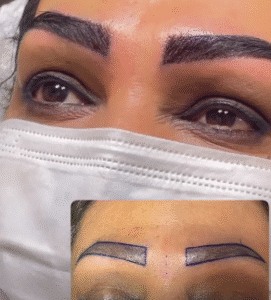 نمونه کاشت ابرو کلینیک زیبایی دنیز