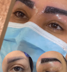 نمونه کاشت ابرو کلینیک زیبایی دنیز