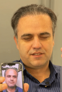 نمونه کاشت مو کلینیک زیبایی دنیز