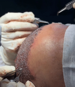 نمونه کاشت مو کلینیک زیبایی دنیز