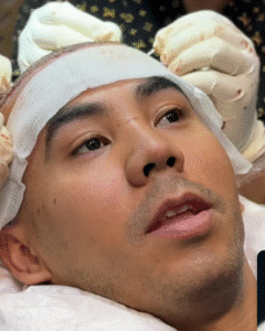 نمونه کاشت مو کلینیک زیبایی دنیز