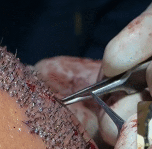 نمونه کاشت مو کلینیک زیبایی دنیز