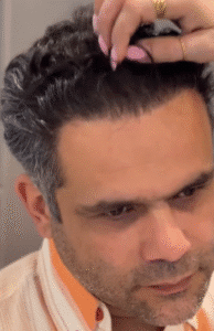 نمونه کاشت مو کلینیک زیبایی دنیز