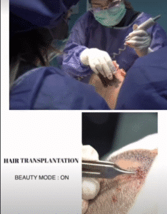 کاشت مو کلینیک سلامت ایده آل