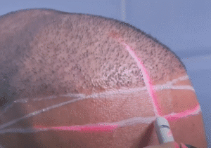 کاشت مو کلینیک سلامت ایده آل