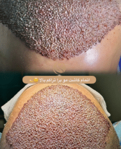 کاشت مو کلینیک سلامت ایده آل