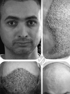 کاشت مو کلینیک سلامت ایده آل