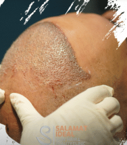 کاشت مو کلینیک سلامت ایده آل