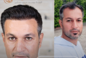 کاشت مو کلینیک سلامت ایده آل