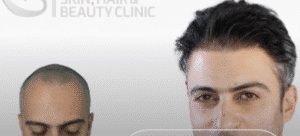 کاشت مو کلینیک سلامت ایده آل