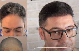 کاشت مو کلینیک سلامت ایده آل