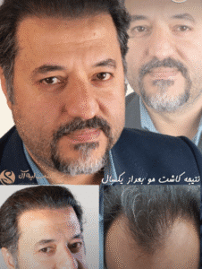 کاشت مو کلینیک سلامت ایده آل